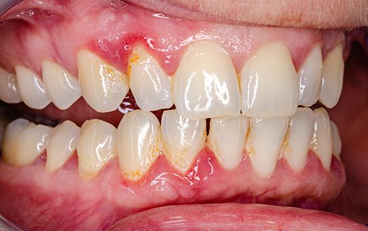 Mauvais alignement dentaire : causes et conséquences - Dr Bach